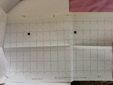 Precordial leads Marco