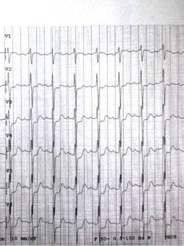 Precordial chest pain