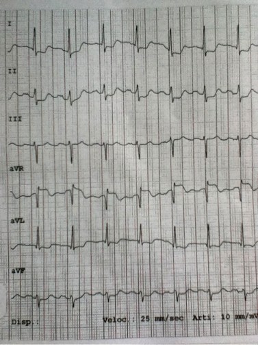 Precordial chest pain