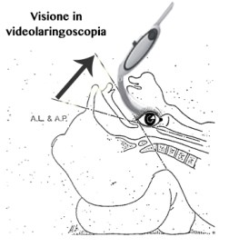 Visione in videolaringoscopia.jpg
